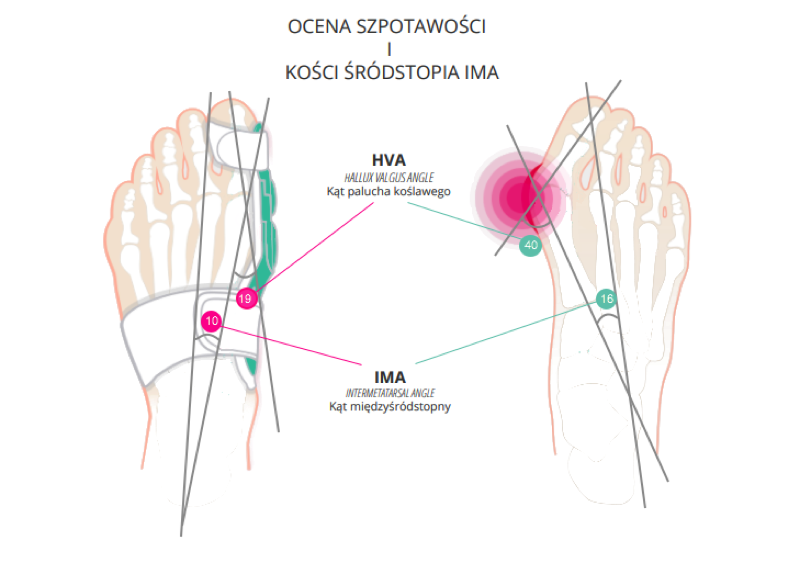 Grafika porównująca stopę z haluksem oraz stopę w aparacie Bunito Duo